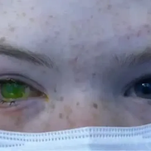 Doença deixa olho esverdeado e provoca dor intensa em pacientes na Austrália