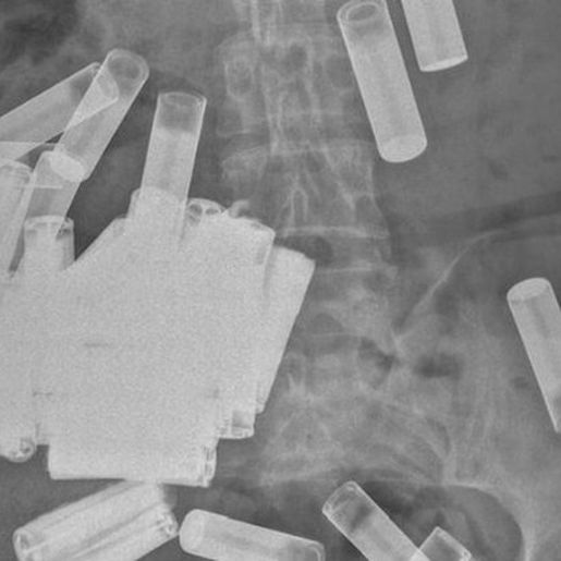 Mulher com 55 pilhas dentro do corpo deixa médicos chocados: 'Maior quantidade engolida'